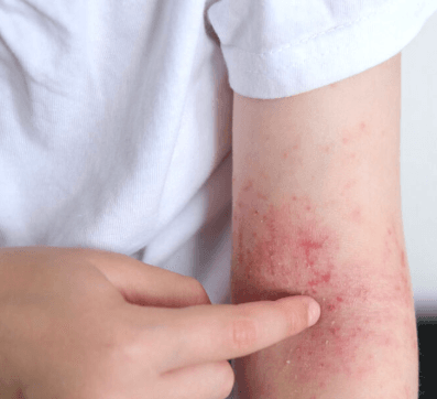 Eczema rash symptoms