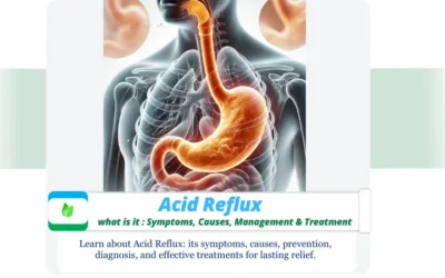 Acid Reflux : Causes, Symptoms, Prevention, & Treatment – Gastroesophageal Reflux – Realistic medical illustration showing acid reflux with acid flowing back from the stomach into the esophagus