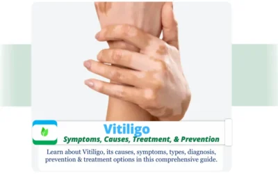 Vitiligo : Symptoms,Causes, Treatment, & Prevention Vitiligo title design featuring skin pigmentation variations